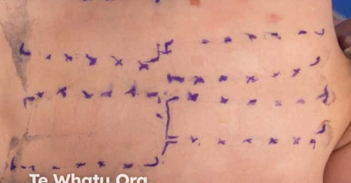 Patch test 48 hours image