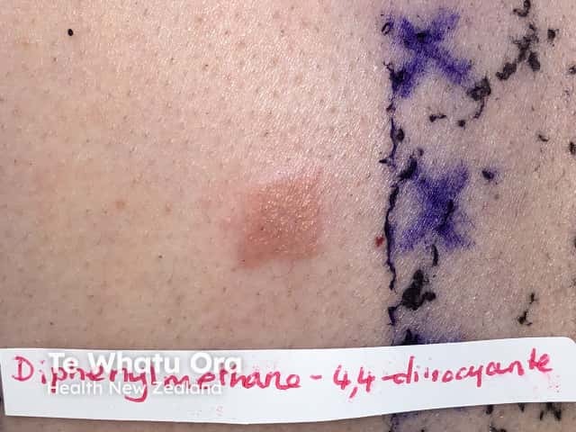 Patch test to isocyanate