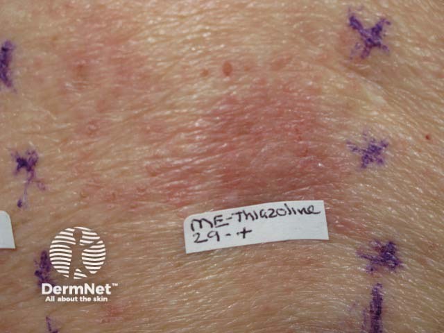 Positive patch test to methylisothiazolinone