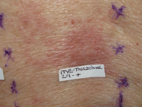 Positive patch test to methylisothiazolinone