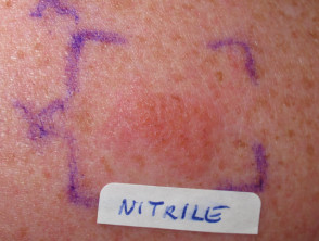 Positive patch test to nitrile