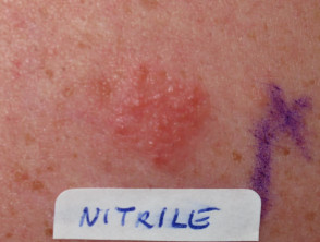 Positive patch test to nitrile