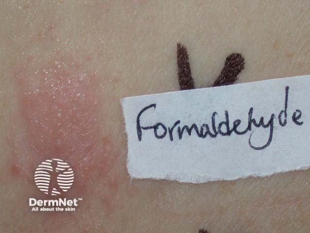 Positive patch test reaction to formaldehyde