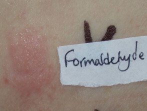Positive patch test to formaldehyde