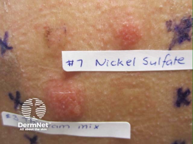 Positive patch test reaction to nickel, thiuram