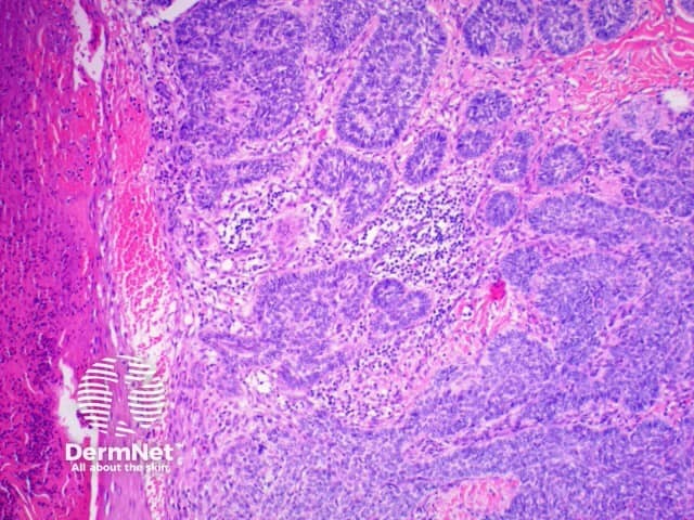Pathology of basal cell carcinoma