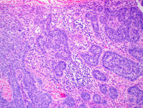 Pathology of basal cell carcinoma