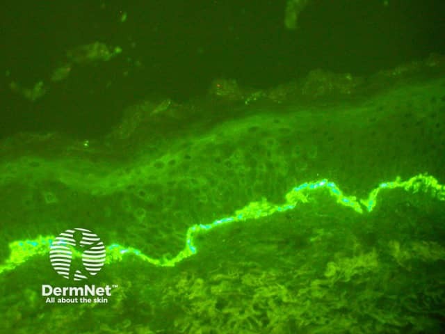 Direct immune fluorescence