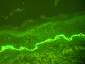 Immunofluorescence staining of basement membrane by IgG in bullous pemphigoid
