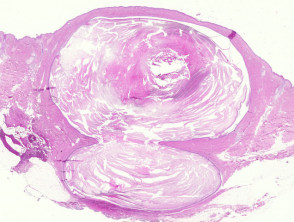 Pathology of epidermoid cyst