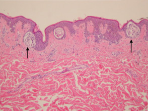 Pathology of junctional naevus