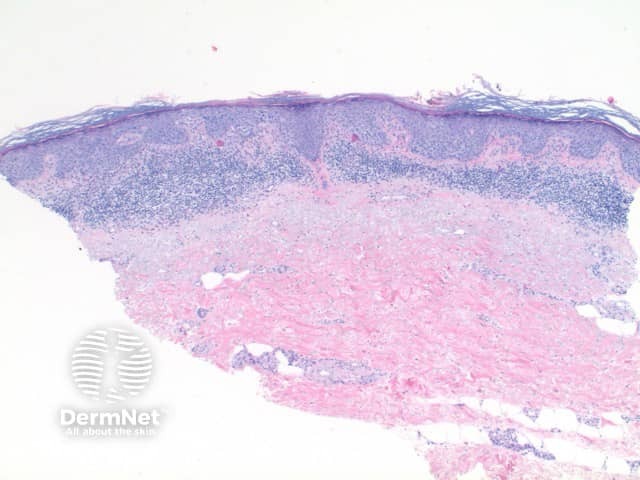 Pathology of squamous cell carcinoma in situ