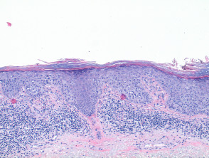 Pathology of squamous cell carcinoma in situ