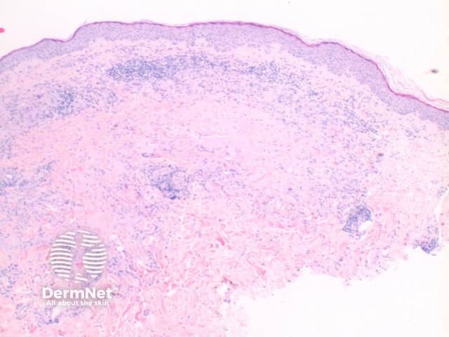 Pathology of granuloma annulare