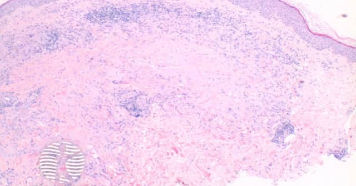 Dermnet® Pathology Of Granuloma Annulare Image