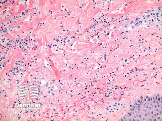 Pathology of leucocytoclastic vasculitis