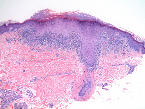 Pathology of lichen planus