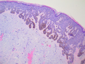 Pathology of pigmented seborrhoeic keratosis