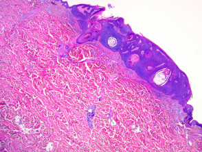 Pathology of seborrhoeic keratosis