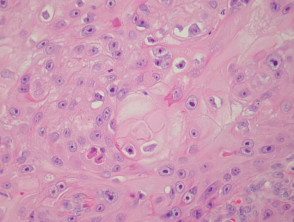 Pathology of squamous cell carcinoma keratinisation