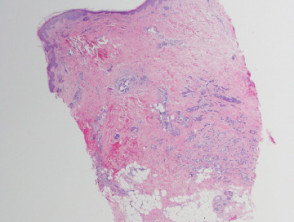 Carcinoma erysipeloides