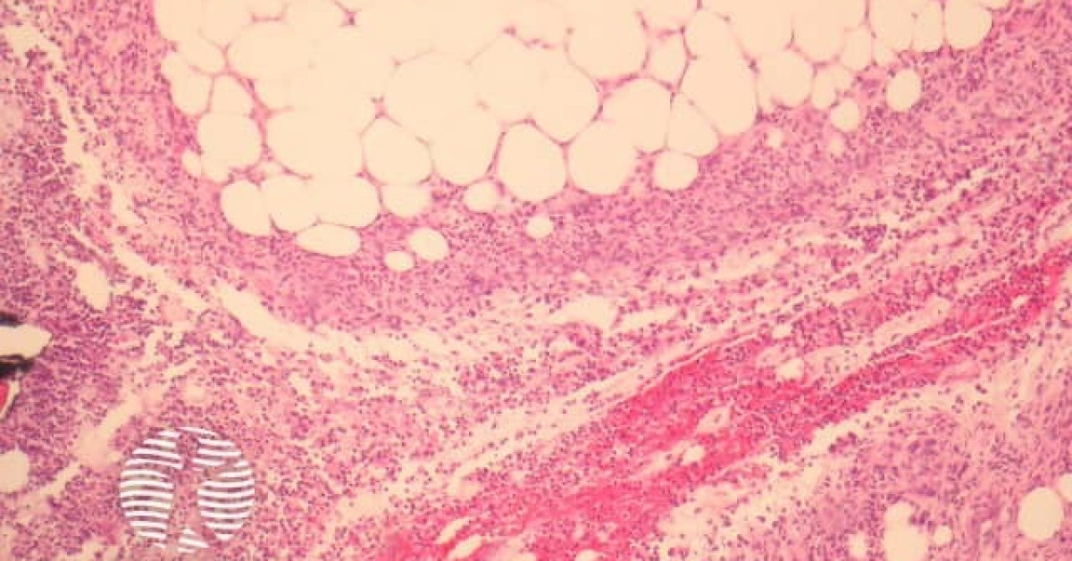 DermNet® - Alpha-1-antitrypsin Deficiency Panniculitis Pathology Image