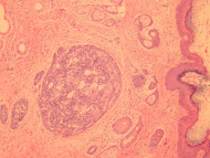Adenoid cystic carcinoma pathology