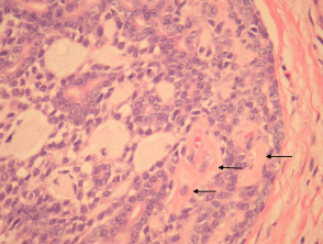 Adenoid cystic carcinoma pathology | DermNet