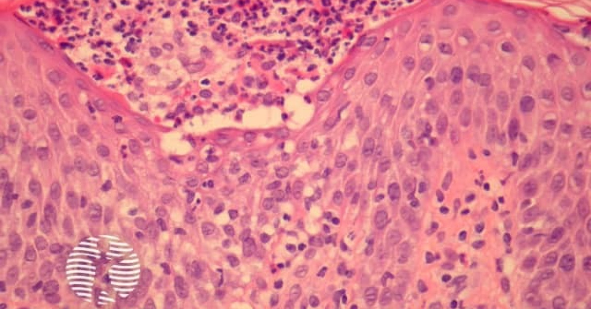 DermNet® - Acute Generalised Exanthematous Pustulosis (AGEP) pathology ...