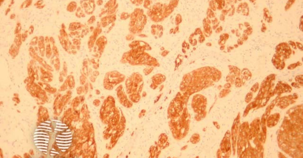 Pigmented spindle cell naevus of Reed pathology image