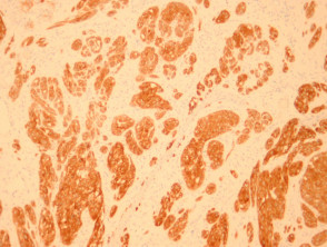 Pigmented spindle cell naevus of Reed pathology