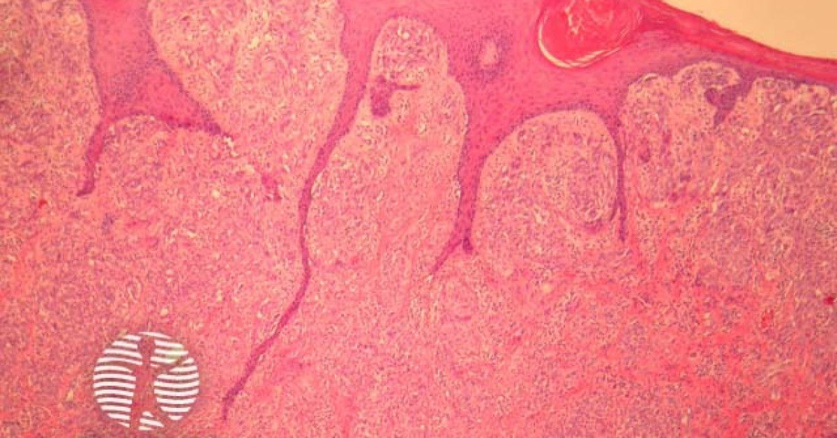 Pigmented spindle cell naevus of Reed pathology image