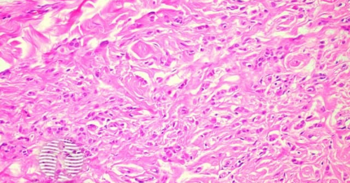 DermNet® - Angiomyofibroblastoma pathology image