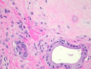 Apocrine mixed tumour (apocrine chondroid syringoma)  pathology