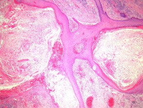 blastomycosis histology