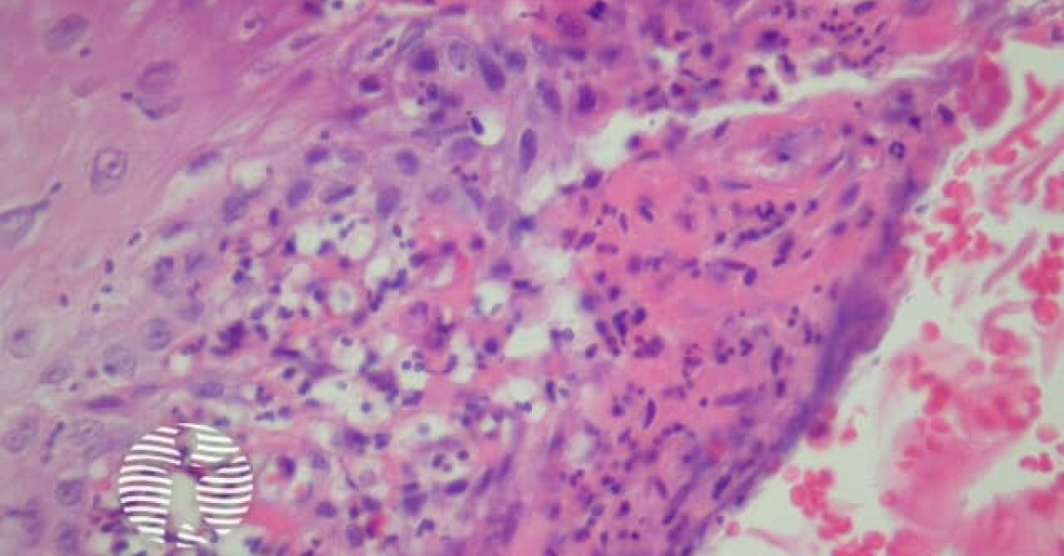 Blastomycosislike pyoderma pathology image