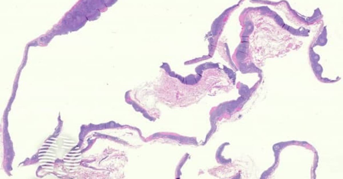 Branchial cleft cyst pathology image