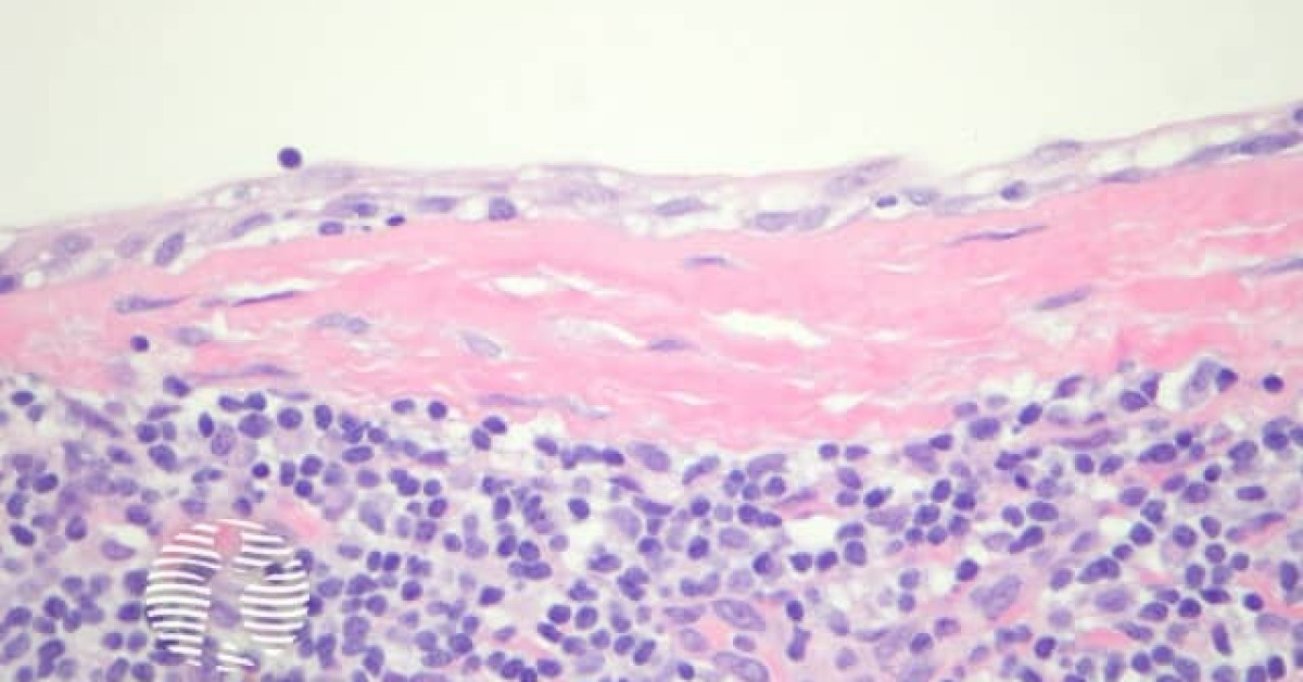 Branchial Cleft Cyst Pathology