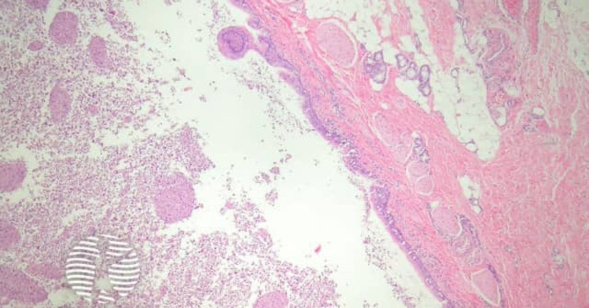 DermNet® - Bronchogenic cyst pathology image