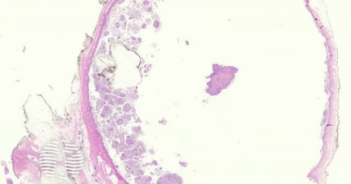 Bronchogenic cyst pathology image