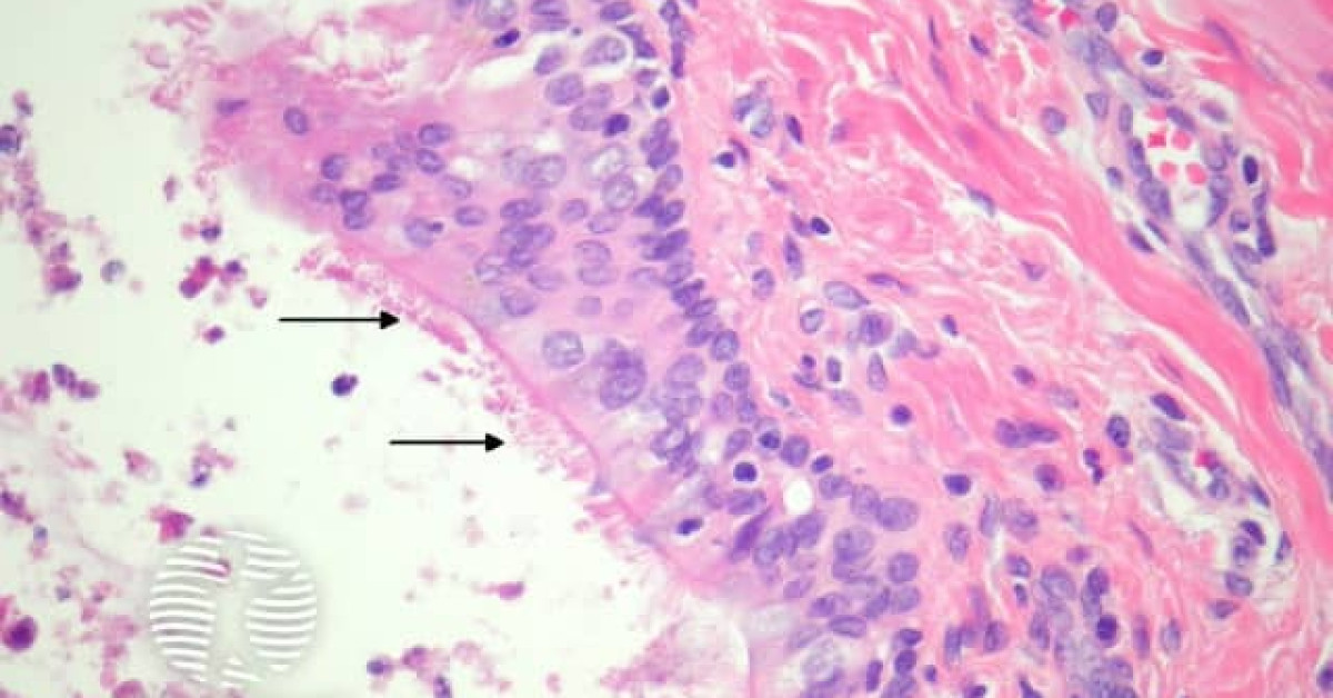 Bronchogenic cyst pathology image