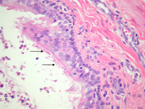 Bronchogenic cyst pathology