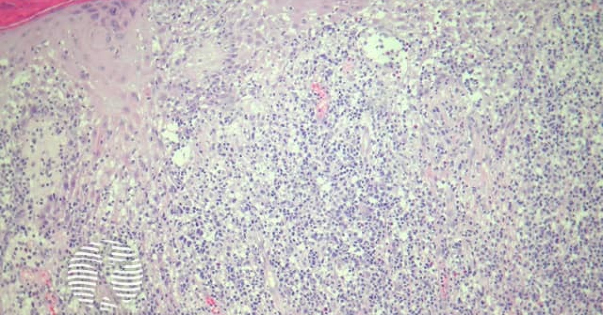 Cutaneous T Cell Lymphoma Dermnet
