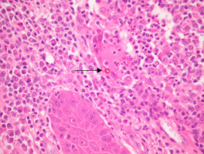 Chromoblastomycosis pathology