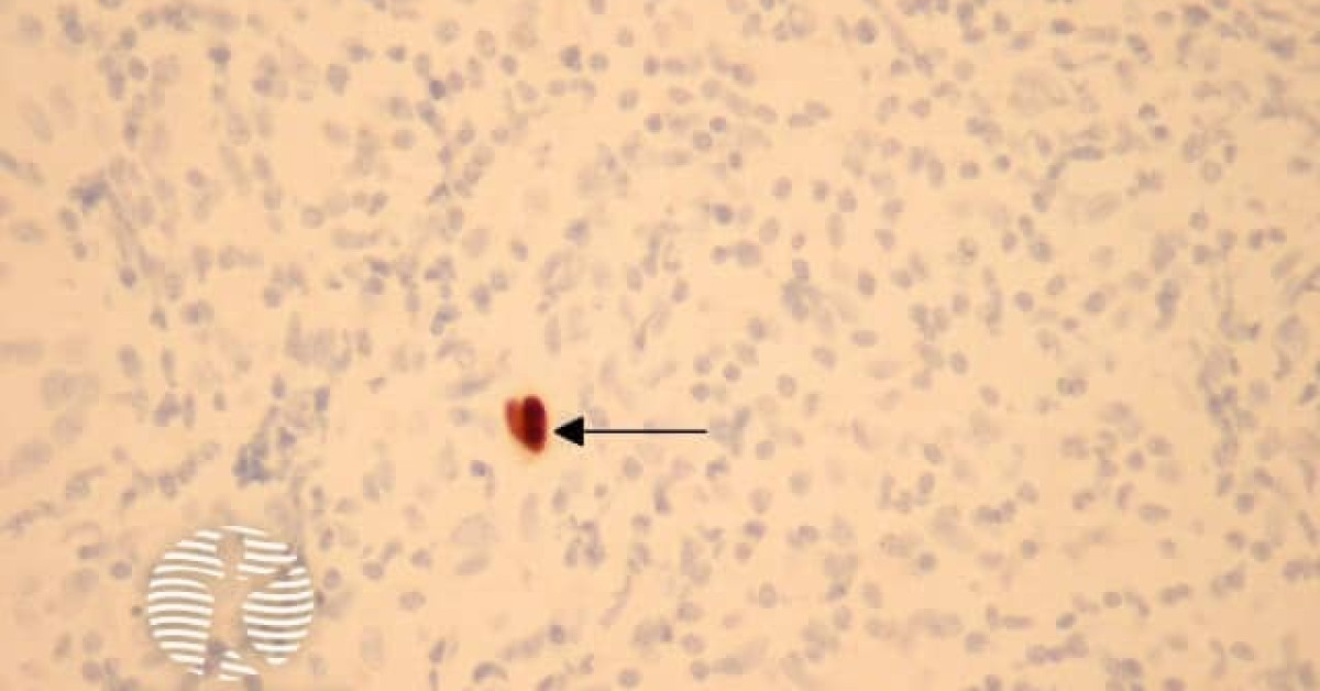 Cytomegalovirus infection pathology image