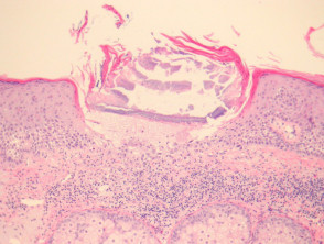 Necrotising infundibular crystalline folliculitis pathology