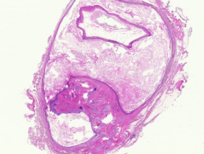 Dermoid cyst pathology