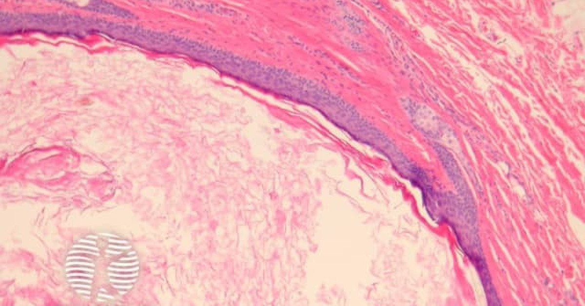 Dermoid cyst pathology image