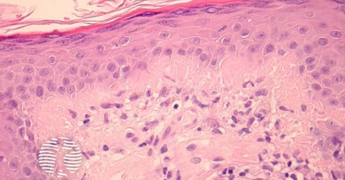 Pathology of discoid lupus erythematosus image