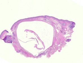 Eccrine hidrocystoma pathology